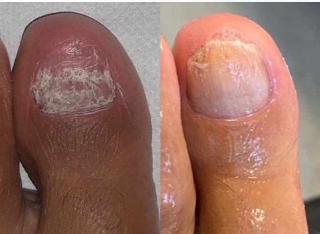 before_and_after_laser_nail